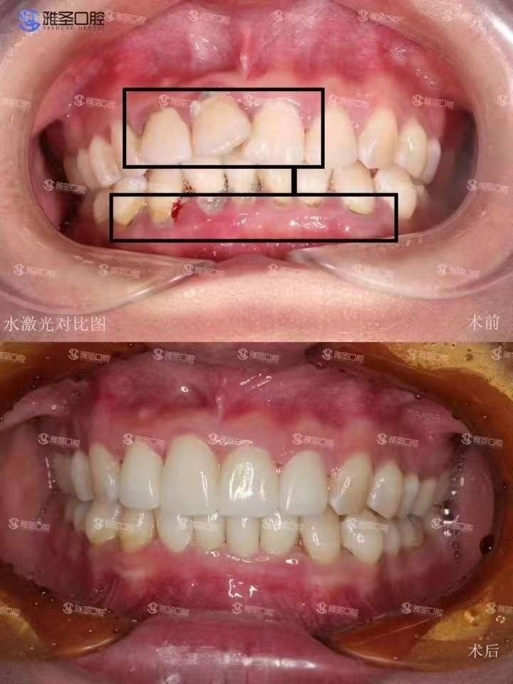 前门牙.虽然你们关心不一般,超越到重叠情