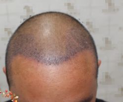 -大麦微针植发丨全国连锁