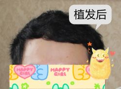 -大麦微针植发全国连锁