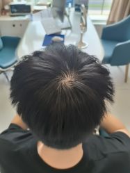 -大麦微针植发全国连锁
