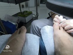 -派恩宜灰指甲鸡眼嵌甲手足癣