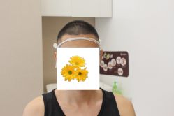 -大麦微针植发丨全国连锁