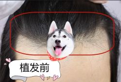 -大麦微针植发全国连锁