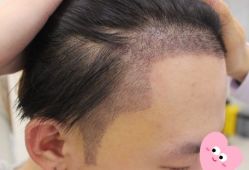 -大麦微针植发丨全国连锁