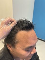 -大麦微针植发全国连锁