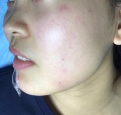 -美丽人生祛斑扁平疣汗管瘤中心