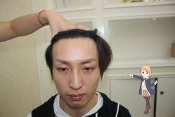 -大麦微针植发丨全国连锁