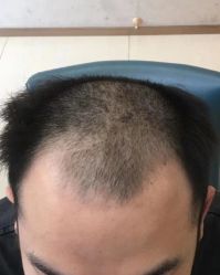 点击看大图 -大麦微针植发丨全国连锁