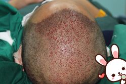 -大麦微针植发丨全国连锁