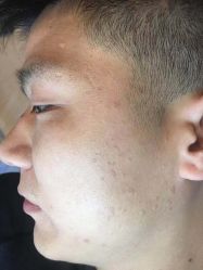 -爱莎扁平疣·汗管瘤·斑痣中心