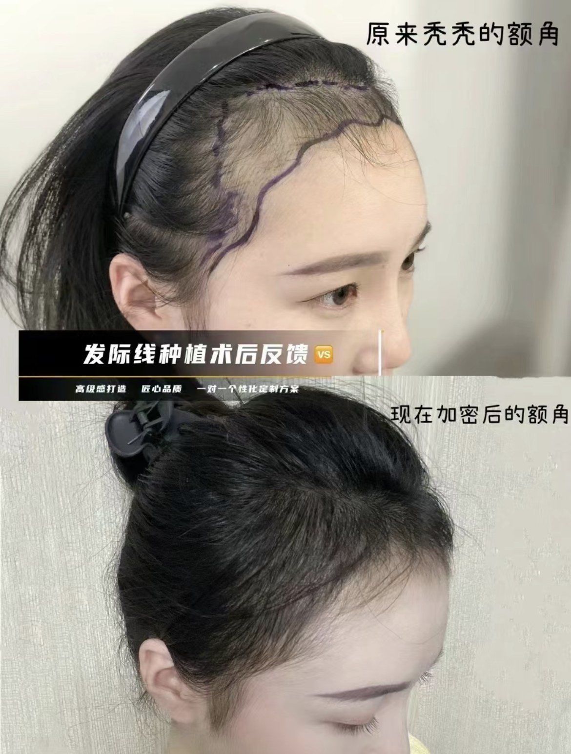 tr无痛发际线植发前后对比图