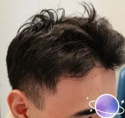 -大麦微针植发丨全国连锁