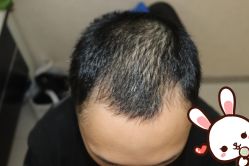 点击看大图 -大麦微针植发丨全国连锁