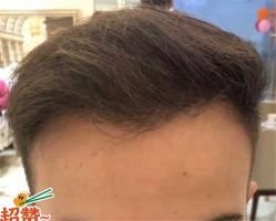 -大麦微针植发全国连锁