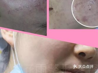 把痘痘里的白色东西挤出来痘痘就能好？