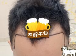 -大麦微针植发全国连锁