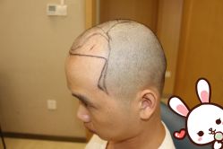 -大麦微针植发丨全国连锁