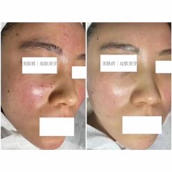 -美肤盾祛痘·问题肌头疗管理中心