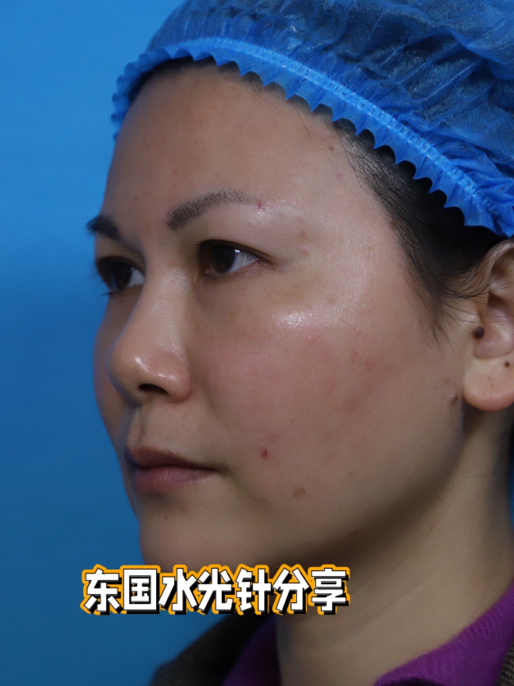 东国水光针分享