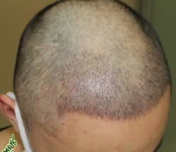 -大麦微针植发丨全国连锁