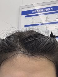 -大麦微针植发全国连锁