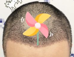 -大麦微针植发全国连锁