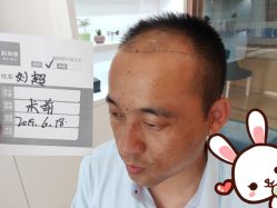 点击看大图 -大麦微针植发丨全国连锁