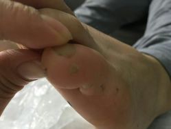 -德哥灰指甲脚气甲沟炎跖疣护理