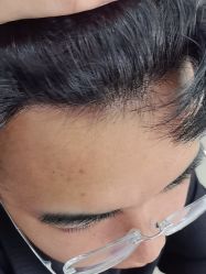 -大麦微针植发丨全国连锁