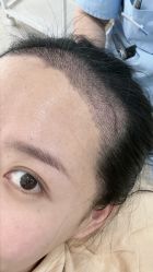 -大麦微针植发丨全国连锁