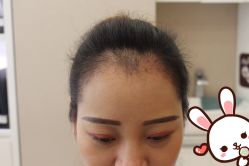 点击看大图 -大麦微针植发丨全国连锁