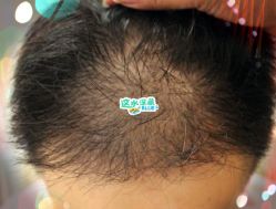 -大麦微针植发全国连锁