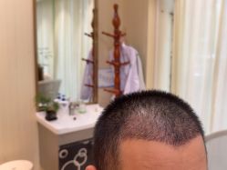 -碧莲盛·不剃发植发