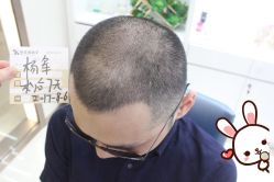 -大麦微针植发丨全国连锁