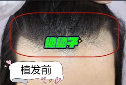 -大麦微针植发全国连锁