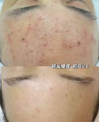 -瑶芳清颜草本祛痘