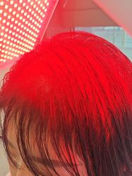 -碧莲盛·不剃发植发