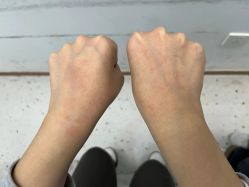 体验后-嘉和医学脱毛中心