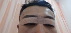 体验后-新美荟医美·专注面部美学抗衰