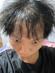 点击看大图 体验前-碧莲盛·不剃发植发