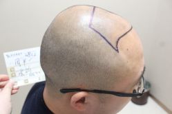 点击看大图 -大麦微针植发丨全国连锁