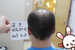 -大麦微针植发丨全国连锁