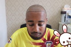 点击看大图 -大麦微针植发丨全国连锁