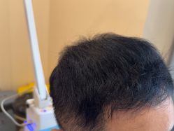 -碧莲盛·不剃发植发