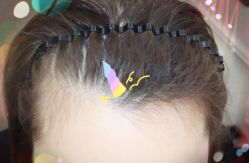 -大麦微针植发全国连锁