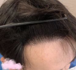 -大麦微针植发丨全国连锁