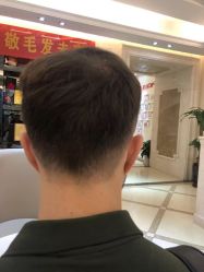 -大麦微针植发丨全国连锁