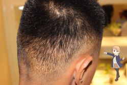 -大麦微针植发丨全国连锁