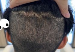 -大麦微针植发全国连锁