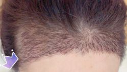 -大麦微针植发丨全国连锁